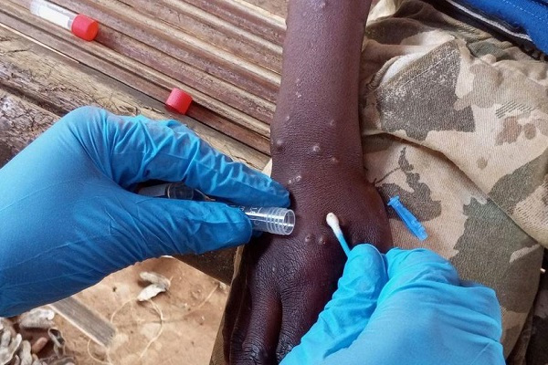 Variole du singe : un premier cas confirmé au Gabon chez un Gabonais en provenance d’Ouganda